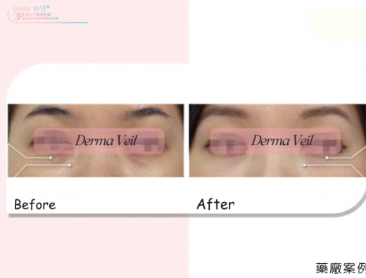 Derma Veil 淚溝部位臨床案例分享