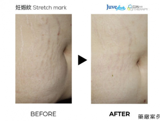 Juvelook 妊娠紋修復臨床案例分享  