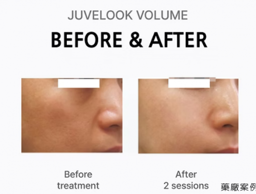 Juvelook Volume 面中飽滿度提升臨床案例分享