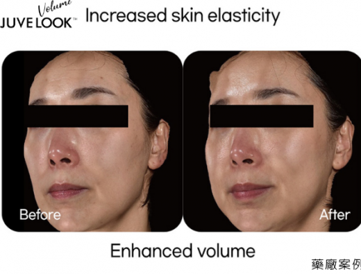Juvelook Volume 面部彈性及飽滿度提升臨床案例分享